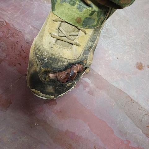 Verbrannte Zehen in Einsatzstiefel linker Fuß