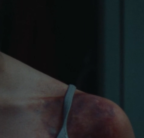 Hämatom Nahansicht Hämatom Nahansicht Makeup SFX Trance